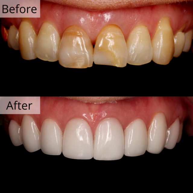 Minish Veneers in Korea English Speaking Veneer Dental Clinic