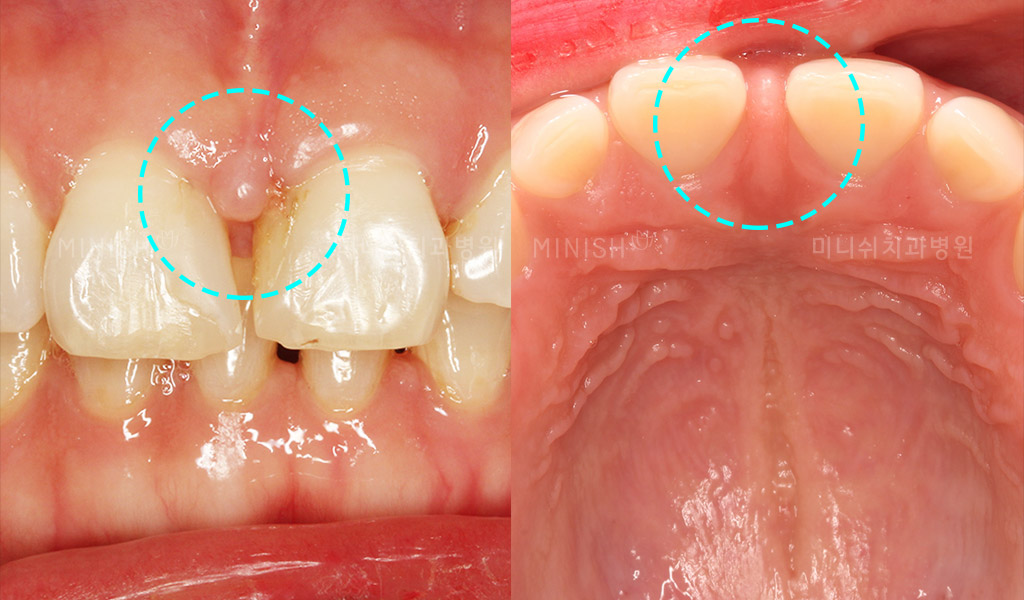 Gap In Teeth What causes gap and what options I have?