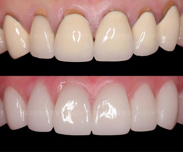 Veneers in Korea Teeth Shaving Methods and Benefits