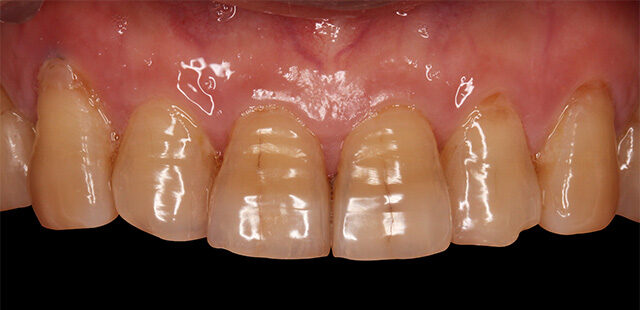 teeth whitening in korea