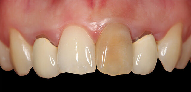 teeth whitening in korea
