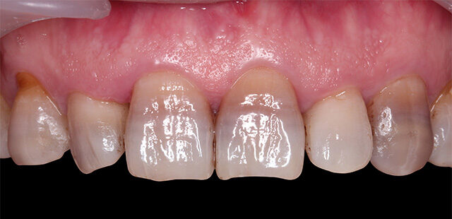 teeth whitening in korea