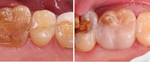 veneers korea