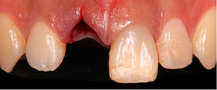 veneers korea