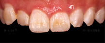 veneers korea
