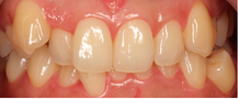 veneers korea