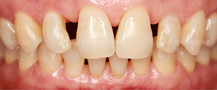 veneers korea