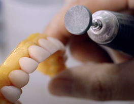veneers south korea minish