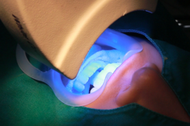 teeth whitening in korea