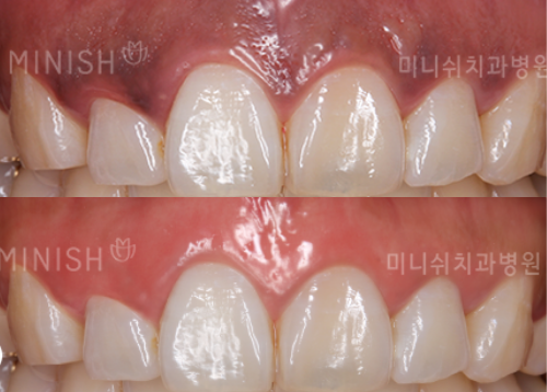 teeth whitening in korea
