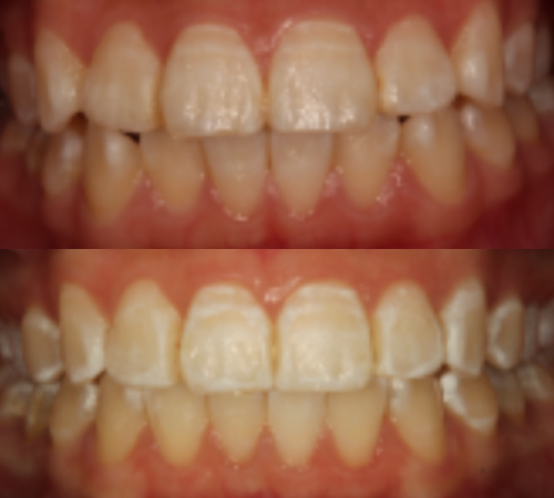 teeth whitening in korea
