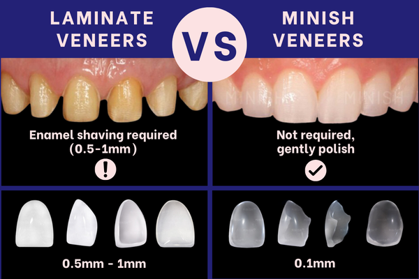 MINISH vs No-Prep Laminate Veneers: What’s the Difference?